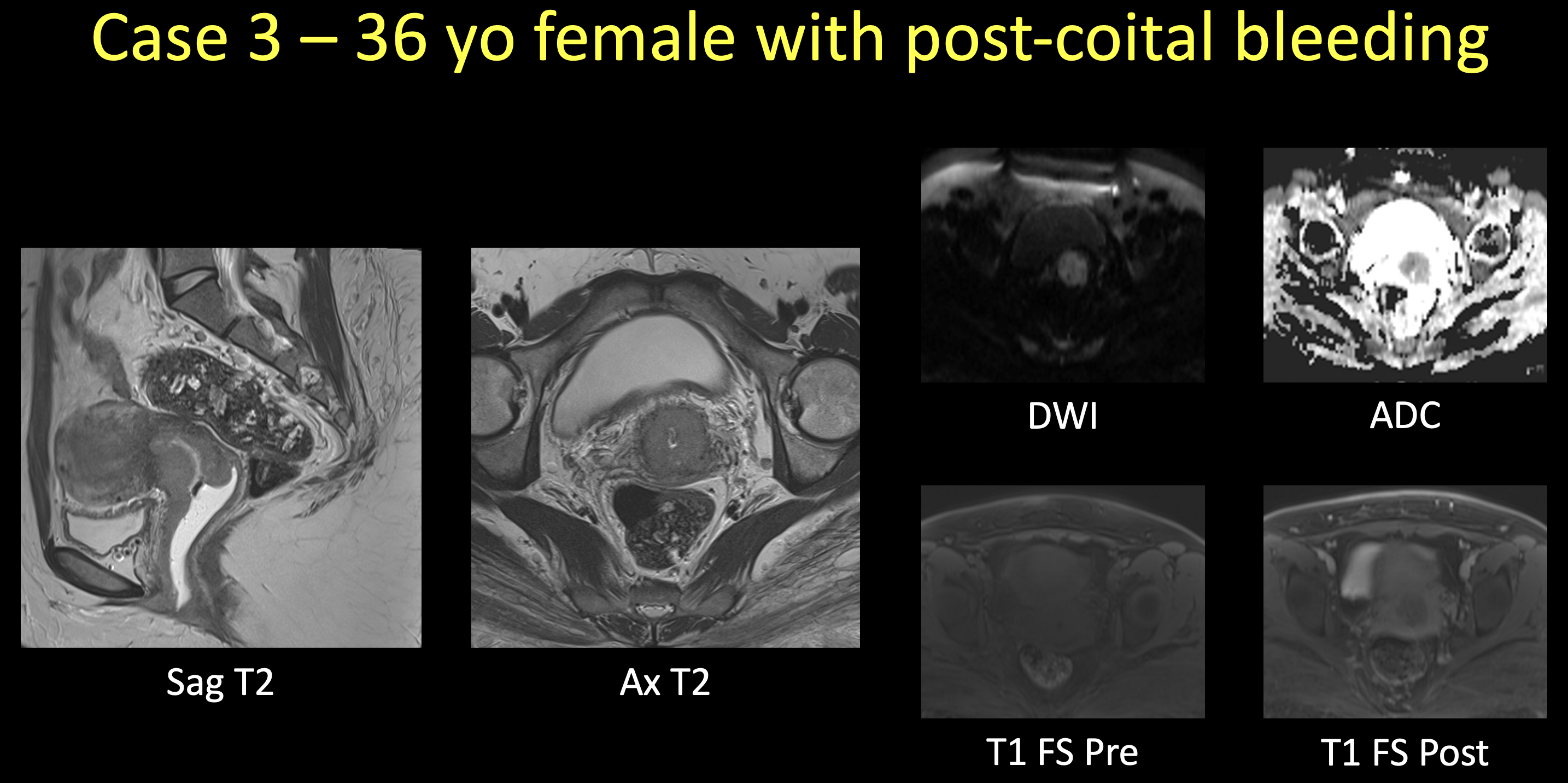 Fibrotic liver elastography