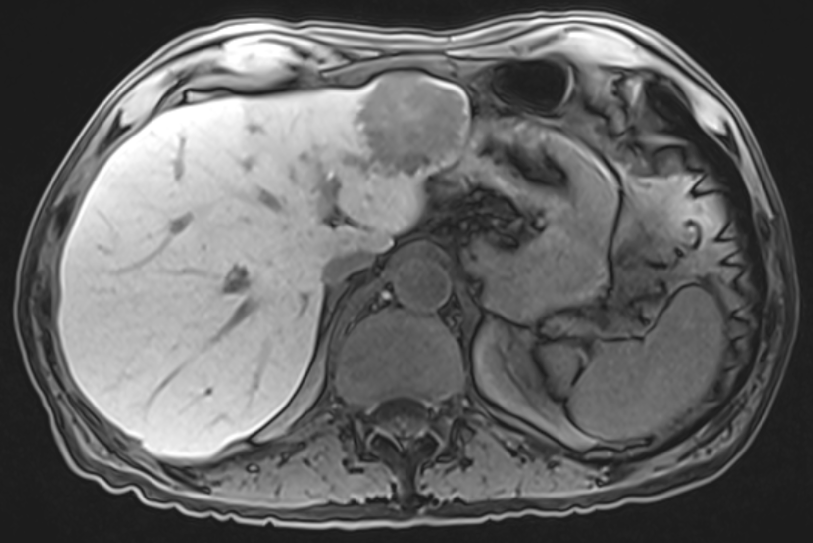 MRI of liver with lesion
