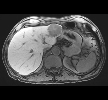 Abbreviated Liver MRI