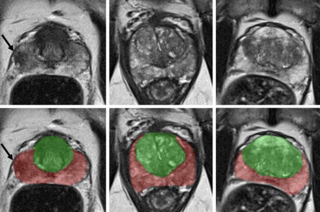 Prostate MRI with zonal segmentation overlays