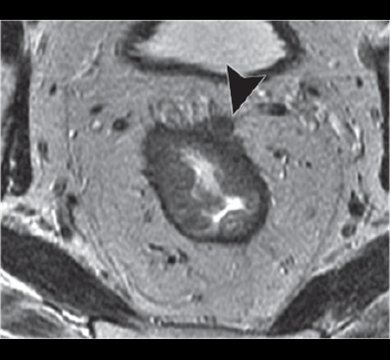 Rectal adenocarcinoma lecture
