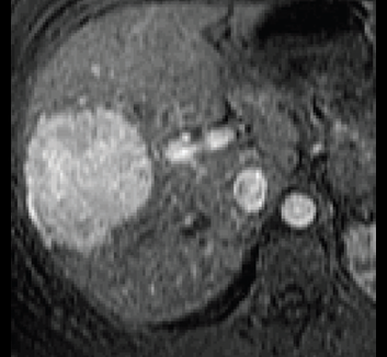 Adenomas lecture
