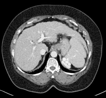 Cirrhosis lecture