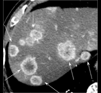 Metastases lecture