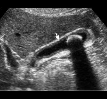 Gallbladder lecture