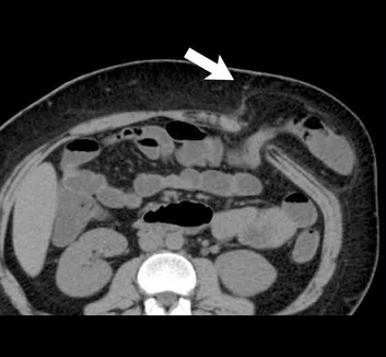 CT image from the abdominal wall hernias lecture