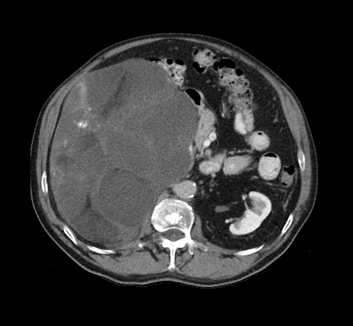 CT image of a retroperitoneal liposarcoma from the adrenal imaging lecture