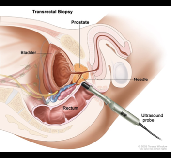 Prostate biopsy lecture