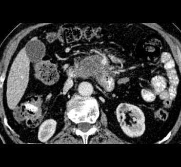 Pancreatic adenocarcinoma lecture